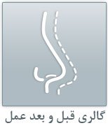 عکس قبل و بعد عمل ترمیم بینی