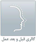 عکس قبل و بعد عمل پلک