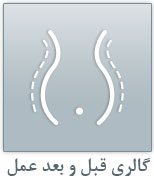 عکس قبل و بعد عمل لیپوساکشن