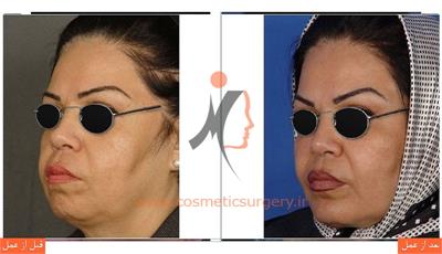 جراحی چانه به همراه تزریق چربی