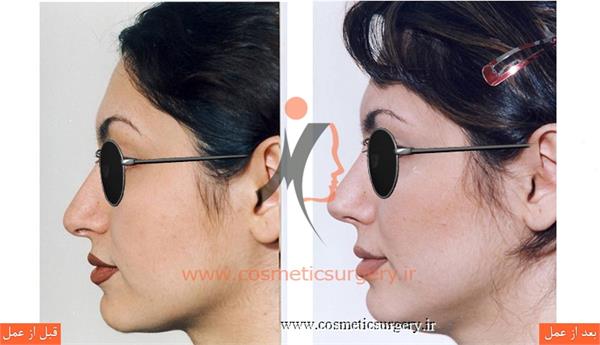 جراحی زیبایی بینی