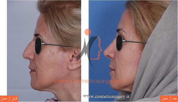 جراحی زیبایی بینی به همراه لیفت ابرو