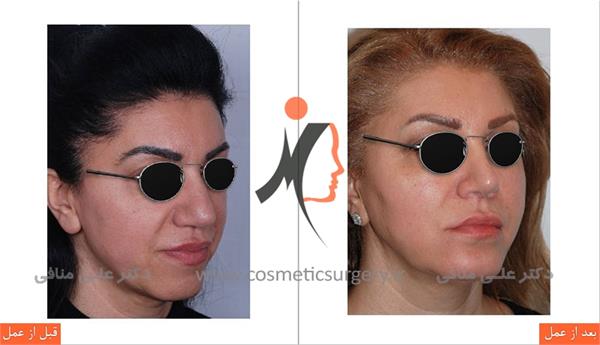 جراحی زیبایی بینی جراحی چانه 1