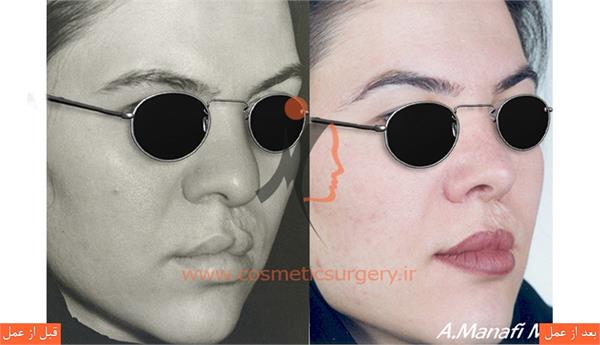 جراحی زیبایی بینی به همراه ترمیم شکاف لب و کام