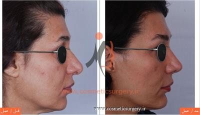 جراحی زیبایی بینی بهمراه لیفت صورت و تزریق چربی