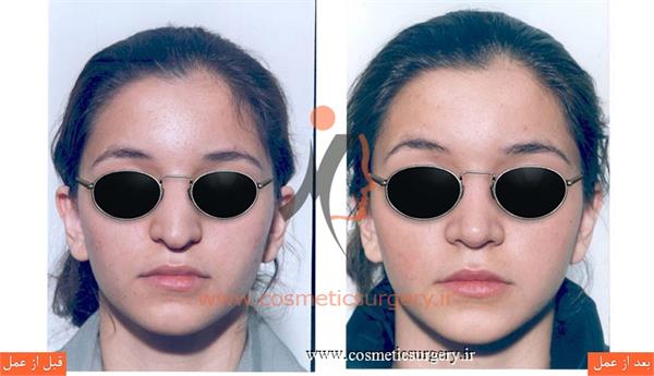 عمل جراحی انحراف بینی