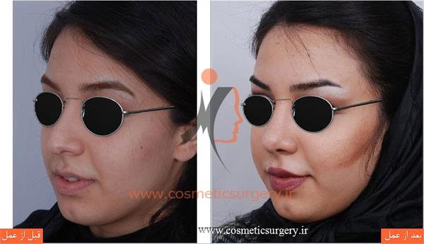 جراحی زیبایی بینی