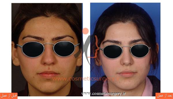 جراحی زیبایی بینی