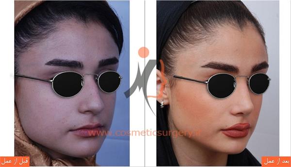 جراحی زیبایی بینی