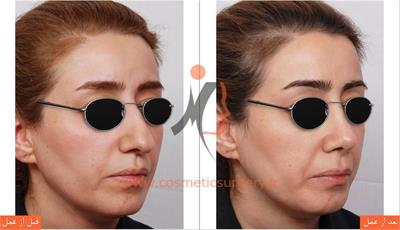 جراحی زیبایی بینی 1