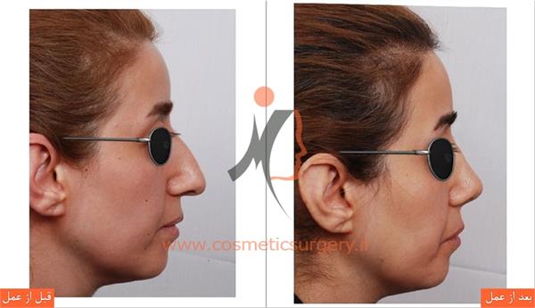 جراحی زیبایی بینی 2