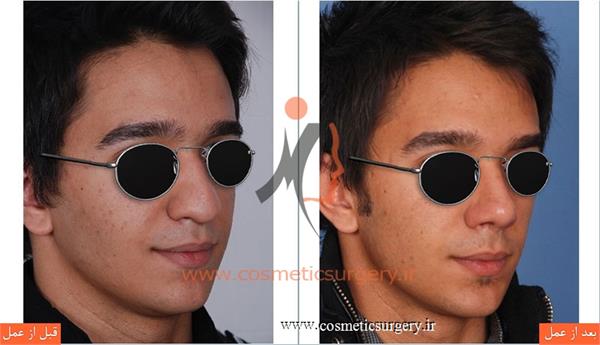 عمل جراحی بینی گوشتی