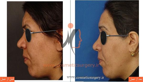 لیفت پیشانی با پوست بسیار ضخیم