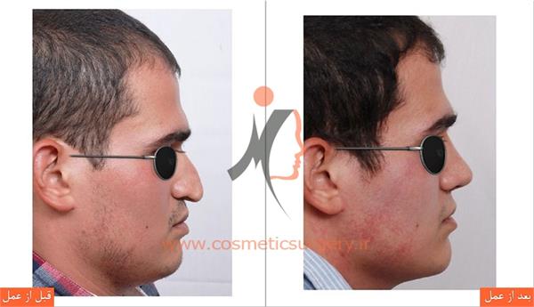 جراحی زیبایی بینی 4