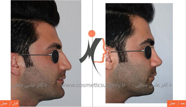 عمل جراحی زیبایی بینی 2