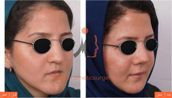 ترمیم بینی عمل شده توسط جراحان دیگر به همراه تزریق چربی و جراحی فک
