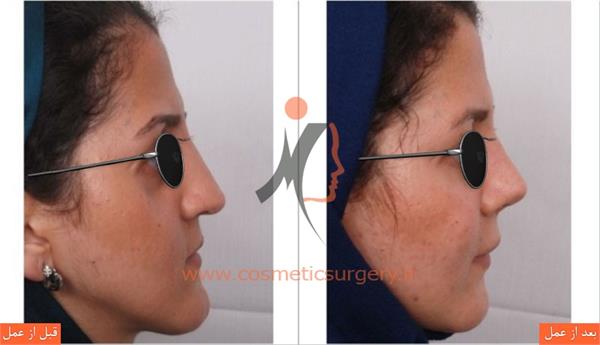 ترمیم بینی عمل شده توسط جراحان دیگر به همراه تزریق چربی و جراحی فک