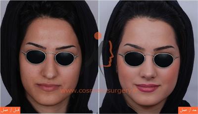 جراحی زیبایی بینی