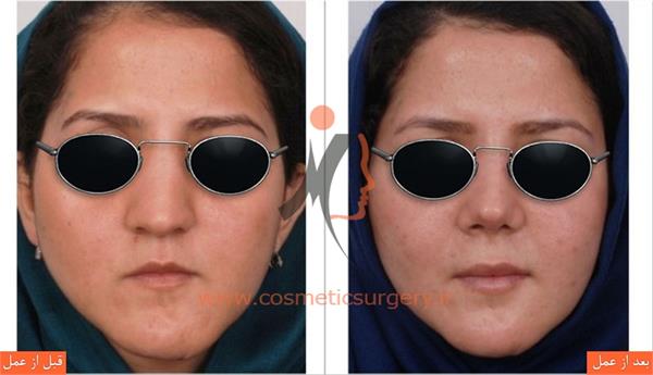ترمیم بینی عمل شده توسط جراحان دیگر به همراه تزریق چربی و جراحی فک