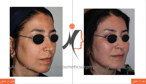 جراحی چانه لیفت ابرو 2