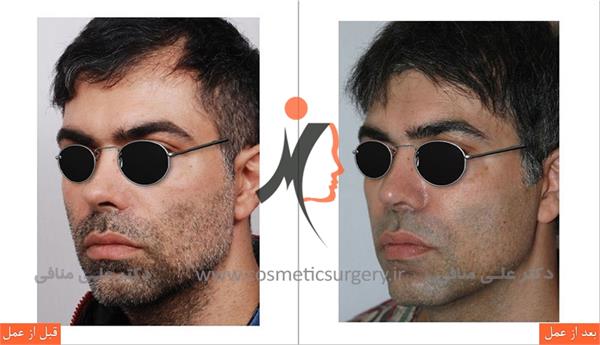 ترمیم بینی، جراحی بینی ثانویه 1