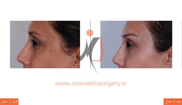 لیفت ابرو به همراه تزریق چربی