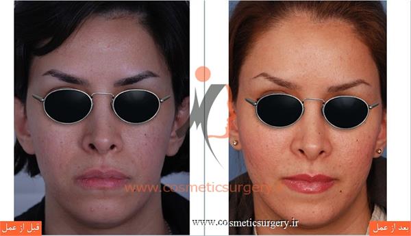 تزریق چربی صورت و گونه