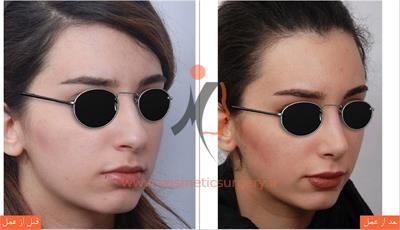 جراحی زیبایی بینی