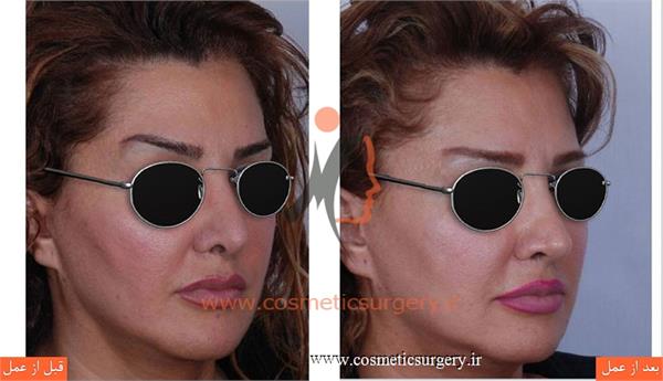 ترمیم بینی در بیماری که قبلا توسط جراحان دیگری عمل شده است