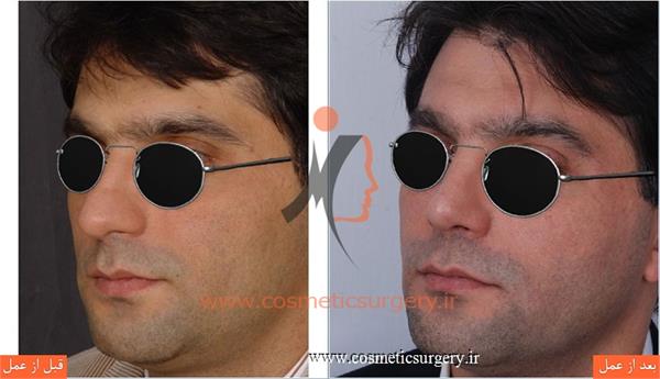 عمل جراحی انحراف بینی