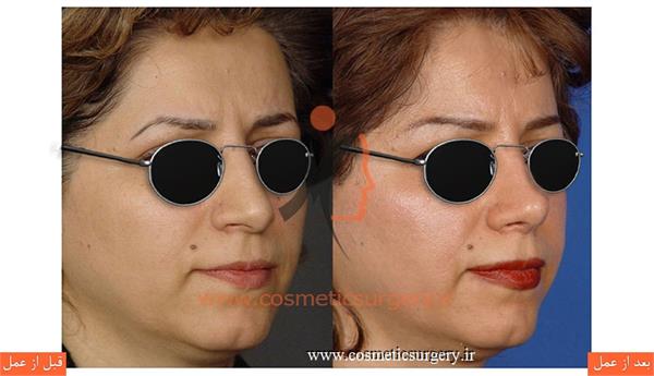 جراحی زیبایی بینی