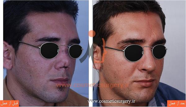 ترمیم بینی در بیماری که قبلا توسط جراحان دیگری عمل شده است