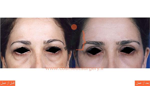 جراحی پلک بالا و پایین
