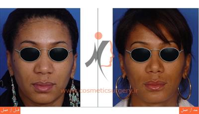 جراحی بینی گوشتی