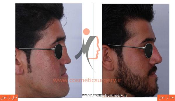 ترمیم بینی در بیماری که قبلا توسط جراحان دیگری عمل شده است