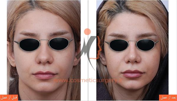 جراحی زیبایی بینی