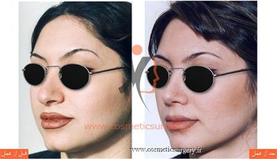 جراحی زیبایی بینی