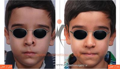 ترمیم نقص مادر زادی بینی