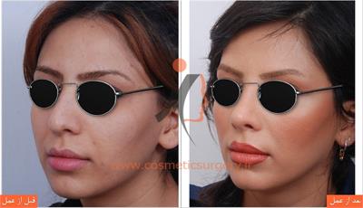 جراحی زیبایی بینی