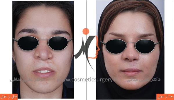 عملية تجميل الأنف شفة الأنف 1