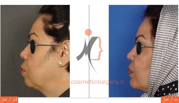 جراحی چانه به همراه تزریق چربی