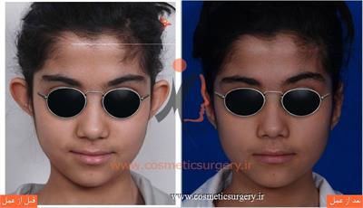 جراحی گوش ( ترمیم گوش برجسته )