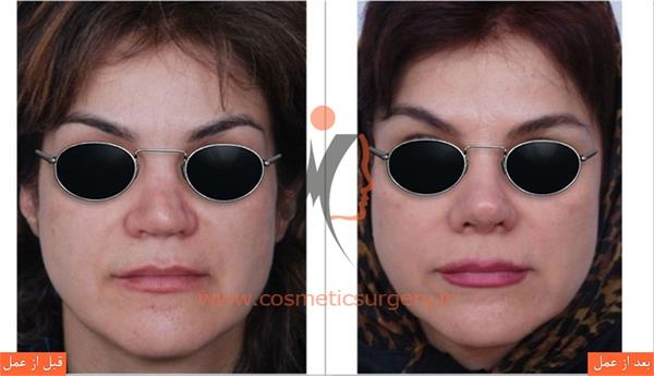 ترمیم بینی در بیماری که قبلا توسط جراحان دیگری عمل شده است