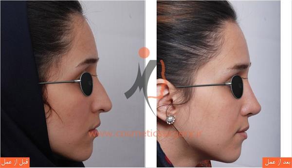 جراحی زیبایی بینی