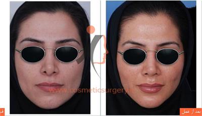 ترمیم بینی به همراه تزریق چربی
