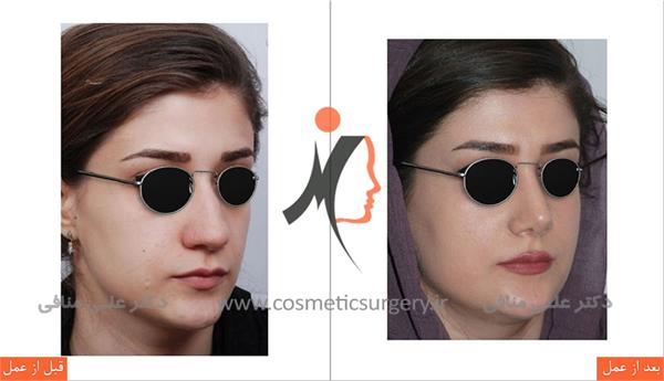 عمل جراحی زیبایی بینی گوشتی 2