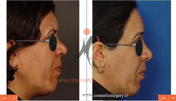 لیفت پیشانی با پوست بسیار ضخیم