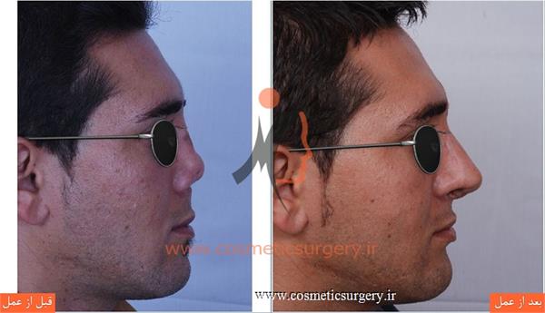 ترمیم بینی در بیماری که قبلا توسط جراحان دیگری عمل شده است