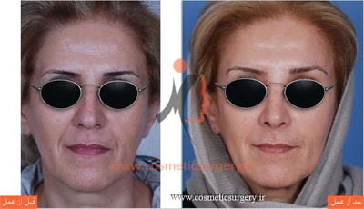 جراحی زیبایی بینی به همراه لیفت ابرو