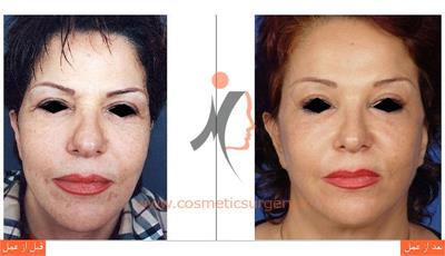 لیفت کامل صورت به همراه جوان سازی دور چشم